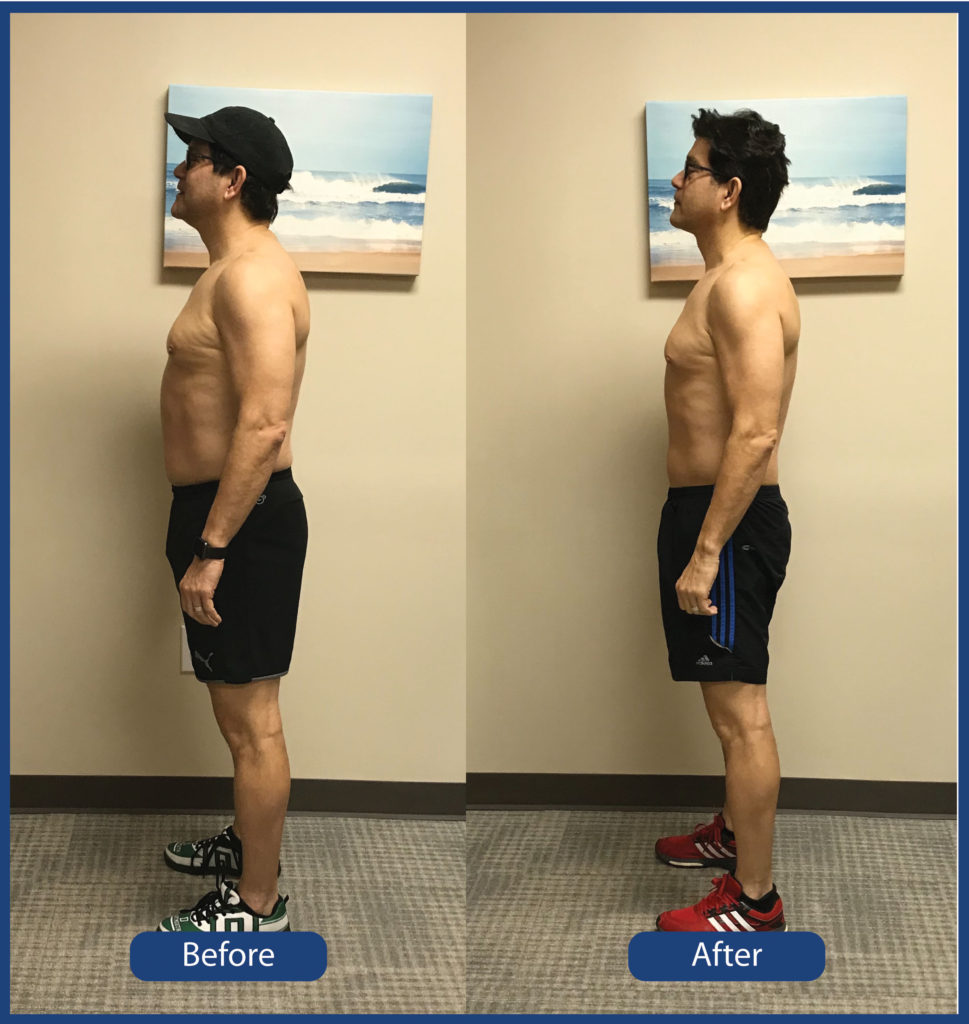 Ross's Before and After photos showing the results of ChiroThin's 6 week program Ballantyne Weight Loss Center at Gallagher Chiropractic and Wellness in Charlotte
